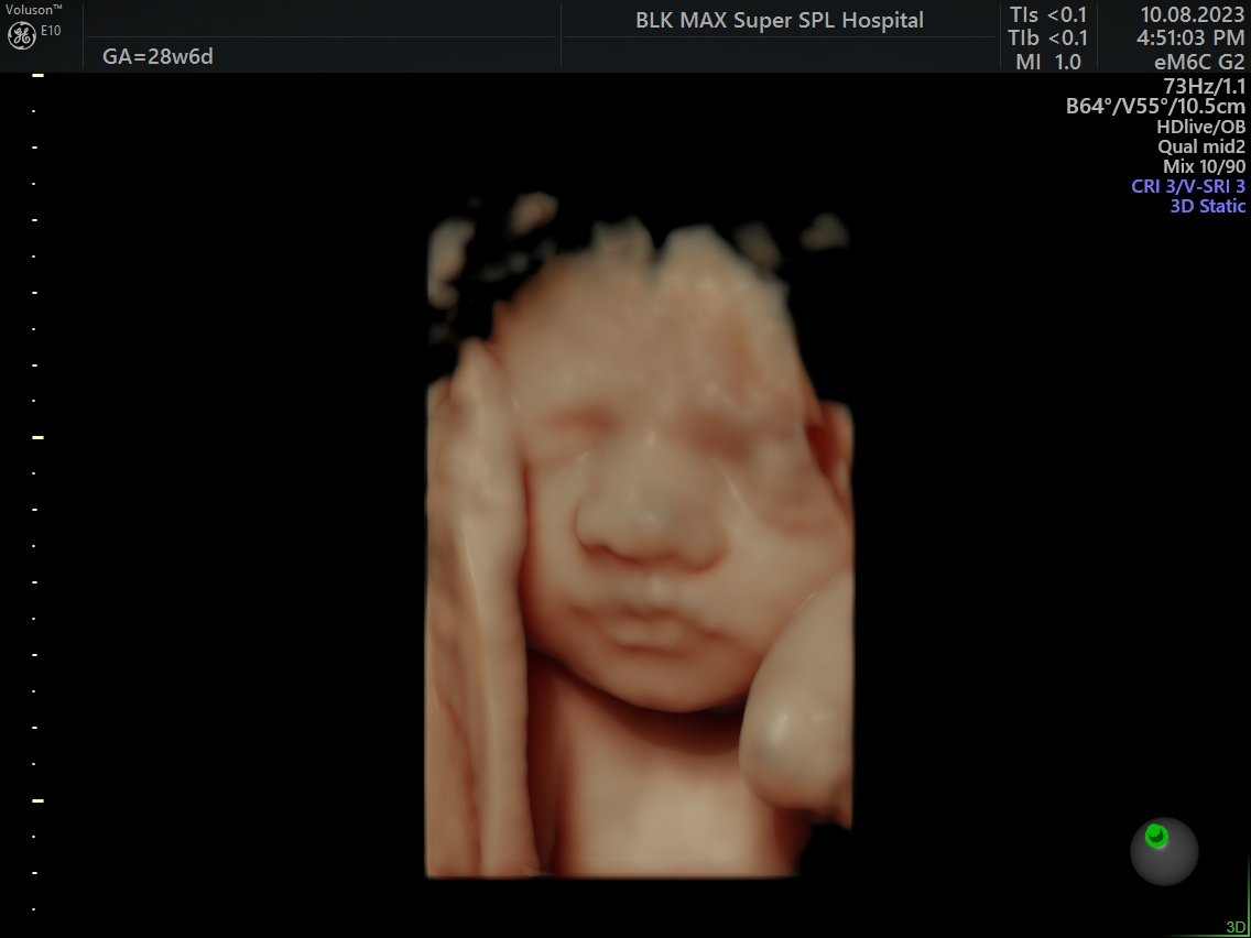 3d/ 4d Ultrasound Scan – Dr. Saloni Arora