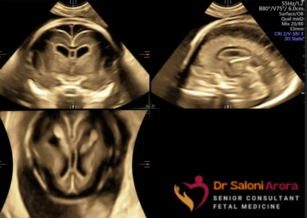 Fetal Neurosonogram