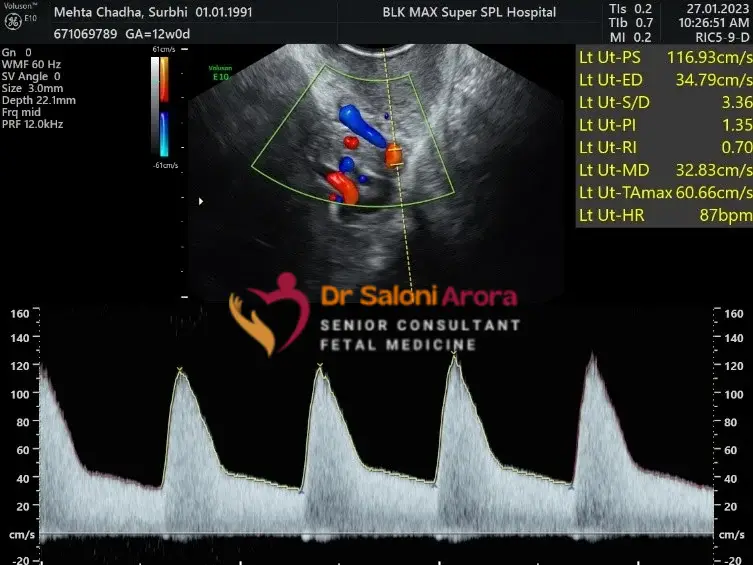 Preclampsia Screening