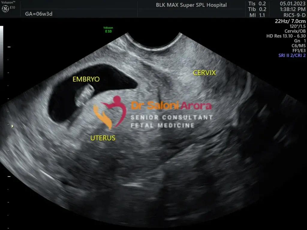 Early Pregnancy Scan